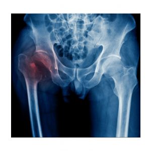 Prótesis de Cadera